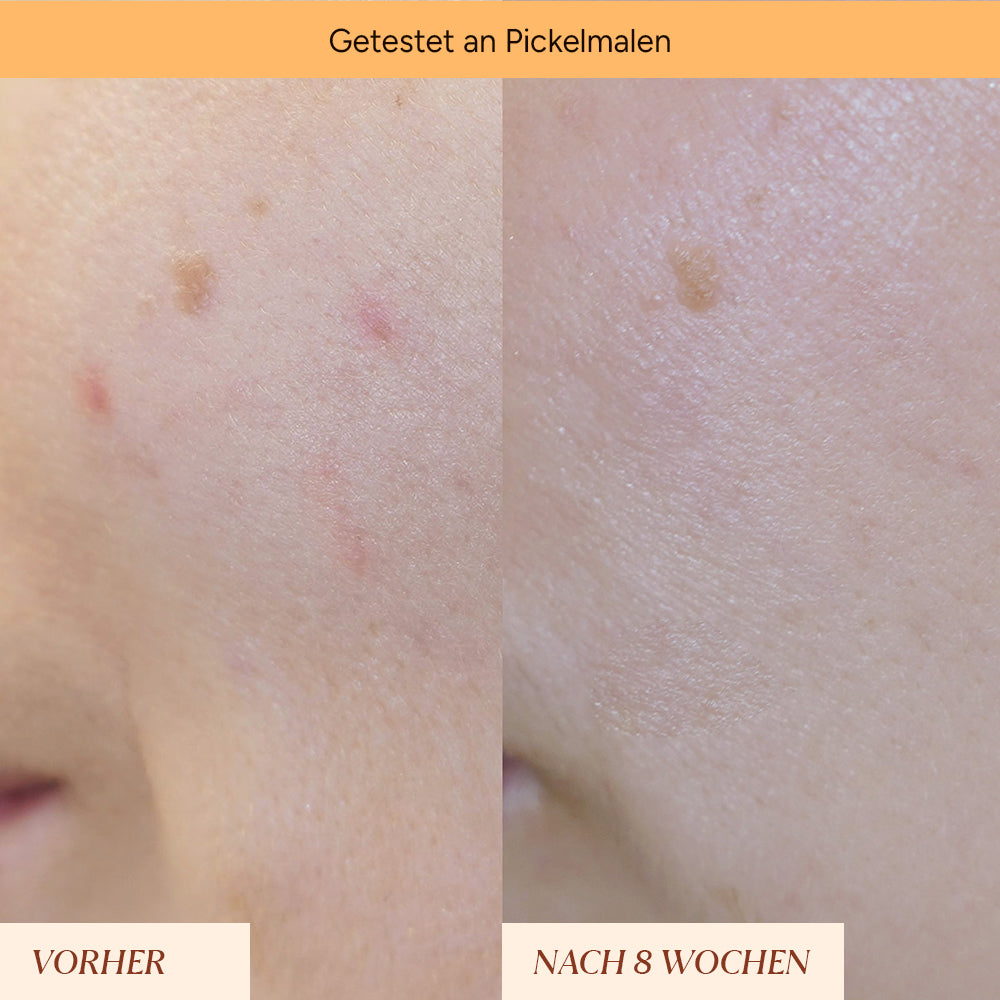 Pigment spots & pimple marks roll-on