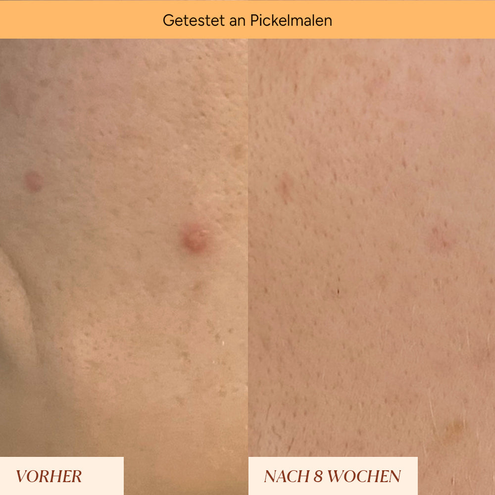 Pigment spots & pimple marks roll-on