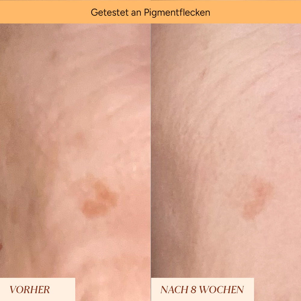 Pigment spots & pimple marks roll-on