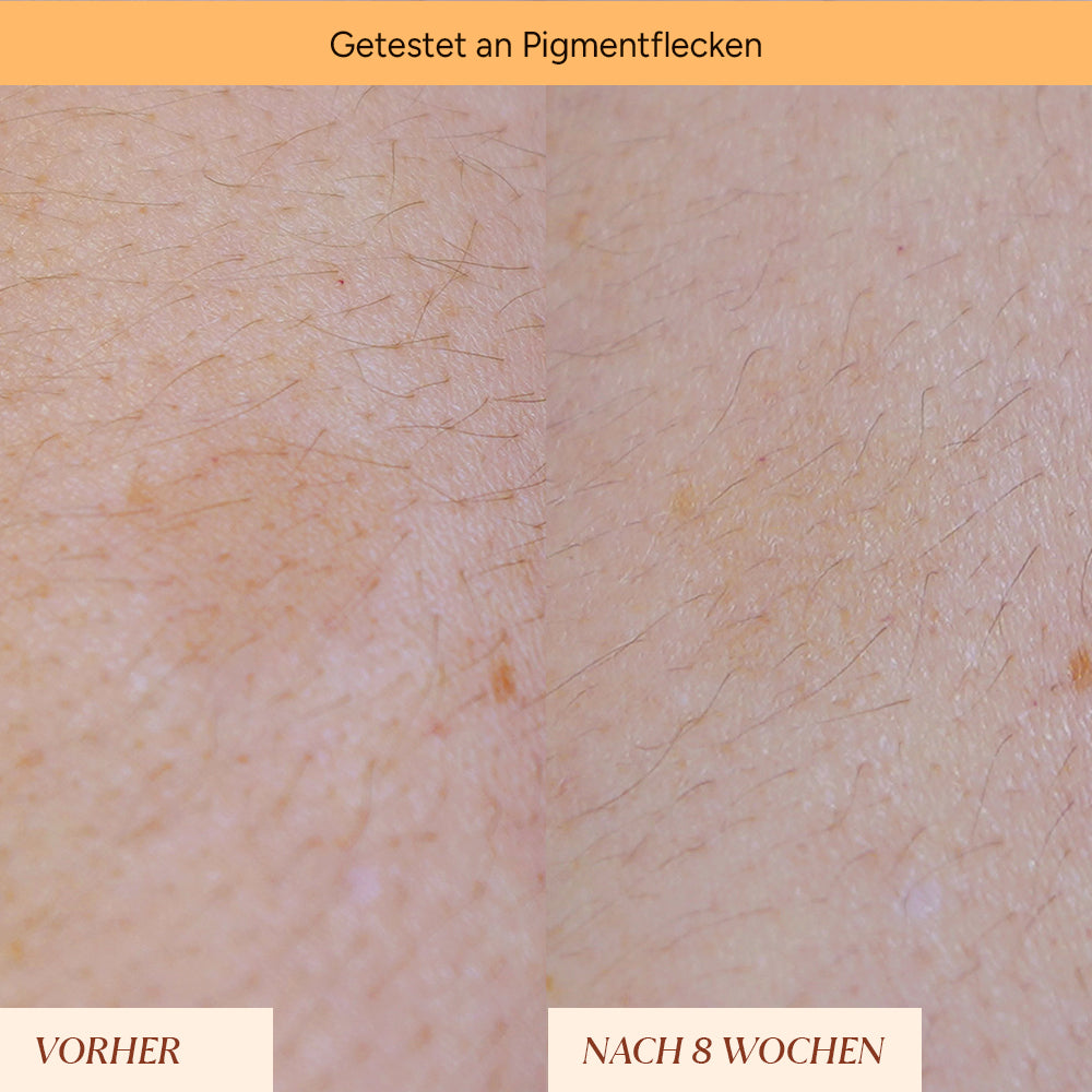 Pigmentflecken & Pickelmale Roll-On